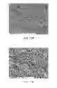 Fig. 14 - Electrospun PTFE coated stent and method of use