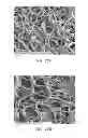 Fig. 15 - Electrospun PTFE coated stent and method of use