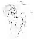 Fig. 09 - Method for determining bone resection on a deformed bone surface from few parameters
