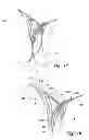 Fig. 02 - Devices, systems and methods for enclosing an anatomical opening