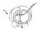 Fig. 01 - Trans-catheter ventricular reconstruction structures, methods, and systems for treatment of congestive heart failure and other conditions