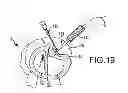 Fig. 32 - Trans-catheter ventricular reconstruction structures, methods, and systems for treatment of congestive heart failure and other conditions