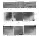 Fig. 40 - Trans-catheter ventricular reconstruction structures, methods, and systems for treatment of congestive heart failure and other conditions