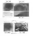 Fig. 45 - Trans-catheter ventricular reconstruction structures, methods, and systems for treatment of congestive heart failure and other conditions