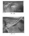 Fig. 49 - Trans-catheter ventricular reconstruction structures, methods, and systems for treatment of congestive heart failure and other conditions