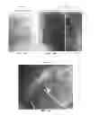 Fig. 52 - Trans-catheter ventricular reconstruction structures, methods, and systems for treatment of congestive heart failure and other conditions