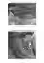 Fig. 53 - Trans-catheter ventricular reconstruction structures, methods, and systems for treatment of congestive heart failure and other conditions