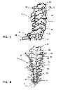 Fig. 02 - Intraoperative spinal stabilization