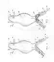 Fig. 02 - Multi-component bifurcated stent-graft systems