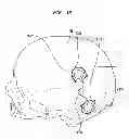 Fig. 16 - IMPLANTABLE MEDICAL DEVICE