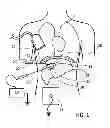 Fig. 02 - Hydrodissection Material with Reduced Migration
