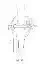 Fig. 02 - Dynamic knee balancer with force or pressure sensing