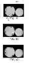 Fig. 08 - PARALLEL MAGNETIC RESONANCE IMAGING USING UNDERSAMPLED COIL DATA FOR COIL SENSITIVITY ESTIMATION