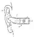 Fig. 01 - Inflatable ear mold connection system