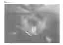 Fig. 02 - Method For Restoring Alveolar Bone Via Transplant of a Regenerated Tooth Unit