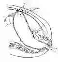 Fig. 01 - Method and apparatus for endoscopically treating rectal prolapse