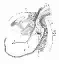 Fig. 09 - Method and apparatus for endoscopically treating rectal prolapse