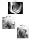 Fig. 07 - Deployment methods and mechanisms for minimally invasive implantation of heart contacting cardiac devices
