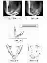 Fig. 09 - Deployment methods and mechanisms for minimally invasive implantation of heart contacting cardiac devices