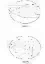 Fig. 09 - Surgical access system with navigation element and method of using same