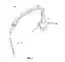 Fig. 06 - Minimally invasive lung volume reduction devices, methods, and systems