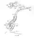 Fig. 40 - Minimally invasive lung volume reduction devices, methods, and systems