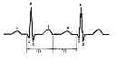Fig. 01 - Methodology for arrhythmia risk stratification by assessing QT interval instability