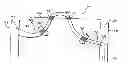 Fig. 01 - Graft-catheter vascular access system