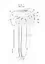 Fig. 02 - Zero-pressure balloon catheter and method for using the catheter