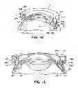 Fig. 22 - Patient interface for ophthalmologic diagnostic and interventional procedures