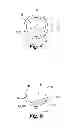 Fig. 04 - Ghost ring guide for assistance in percutaneous insertions