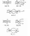 Fig. 03 - Medical retrieval device