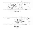 Fig. 07 - Medical retrieval device