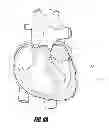 Fig. 07 - Catheter-based tissue remodeling devices and methods