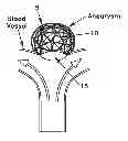 Fig. 01 - Method and apparatus for restricting flow through an opening in the side wall