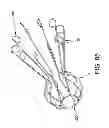 Fig. 44 - Method and apparatus for restricting flow through an opening in the side wall