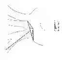 Fig. 02 - Embolic debris deflector