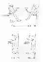 Fig. 02 - Method and apparatus for re-attaching the labrum to the acetabulum, including the provision and use of a novel suture anchor system