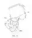 Fig. 06 - Method and apparatus for re-attaching the labrum to the acetabulum, including the provision and use of a novel suture anchor system