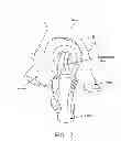 Fig. 08 - Method and apparatus for re-attaching the labrum to the acetabulum, including the provision and use of a novel suture anchor system