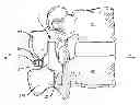 Fig. 01 - SPINOUS PROCESS MOUNTED SPINAL IMPLANT
