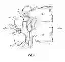 Fig. 02 - SPINOUS PROCESS MOUNTED SPINAL IMPLANT