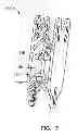Fig. 16 - Bone tissue clamp