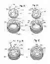 Fig. 07 - Locking device for locking a rod-shaped element in a receiving part of a bone anchor and bone anchor with such a locking device