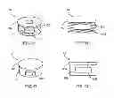 Fig. 09 - Spinal facet fusion device and method of operation