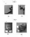 Fig. 03 - Prosthetic Attachment Techniques