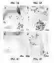 Fig. 04 - Method to treat autoimmune demyelinating diseases and other autoimmune or inflammatory diseases