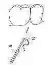 Fig. 01 - Reshapable Device for Fixation at a Dental Site