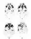 Fig. 01 - Methods for treating post traumatic stress disorder