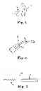 Fig. 02 - Systems, implants, tools, and methods for treatments of pelvic conditions